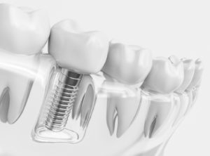 Dental implants the woodlands tx